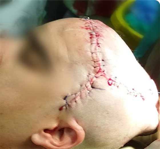 Cranium PEEK implant case 06